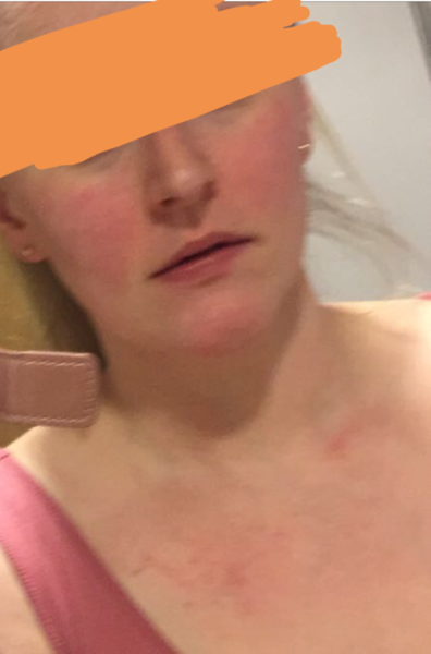 So what's this rash then?!