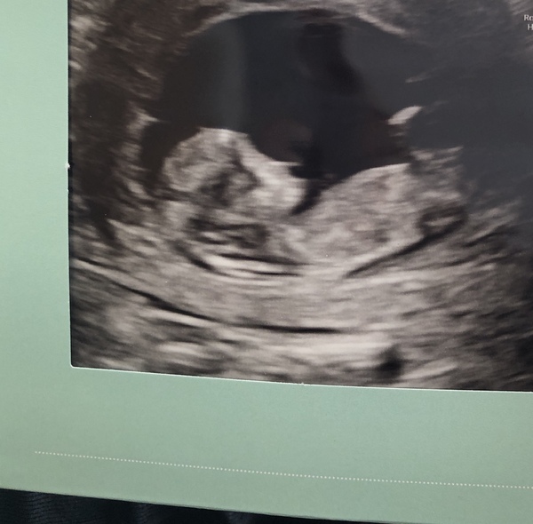What do you think? Girl or boy? ☺️