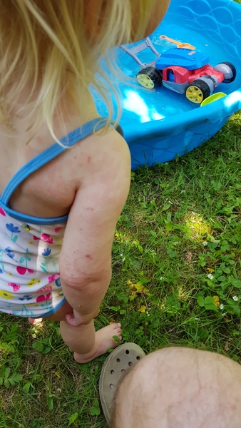 Is this eczema? Or an allergy?