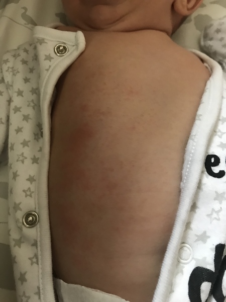 What is this rash?