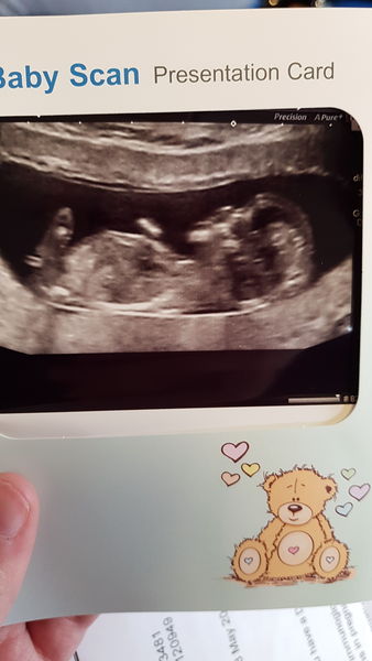 Just had my 12 week scan. Can anyone see nub?