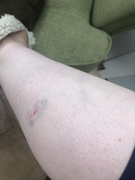 I’ve been bitten by another dog while walking mine