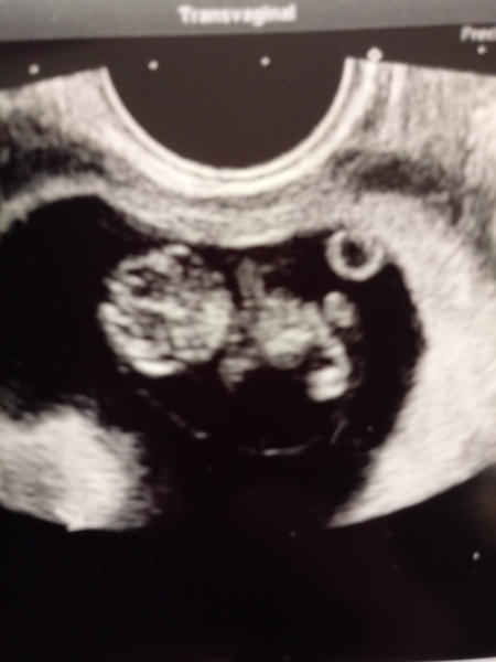The Graduates of TTC after pregnancy loss thread