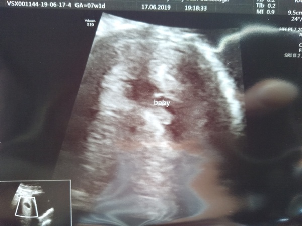 Those who had reassurance scans at 7 weeks