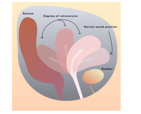To ask if you have (or had) a prolapse after birth? I'm 25 and mortified