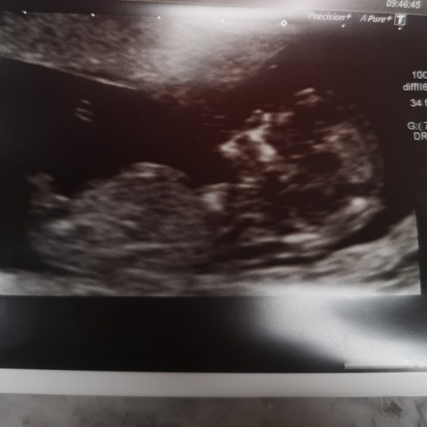 It’s going to absolutely drag until my scan!