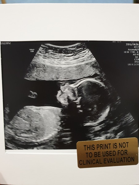 Skull theory at 20 weeks
