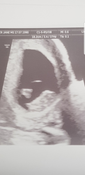 The Graduates of TTC after pregnancy loss thread
