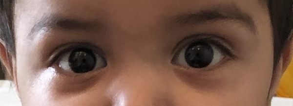 9 months old - bags under eyes