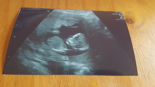 The Graduates of TTC after pregnancy loss thread