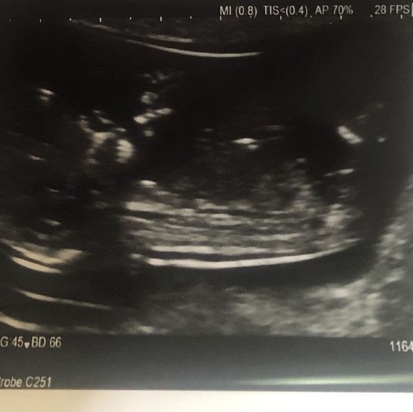 Due 23rd December - any one believe in nub theory?