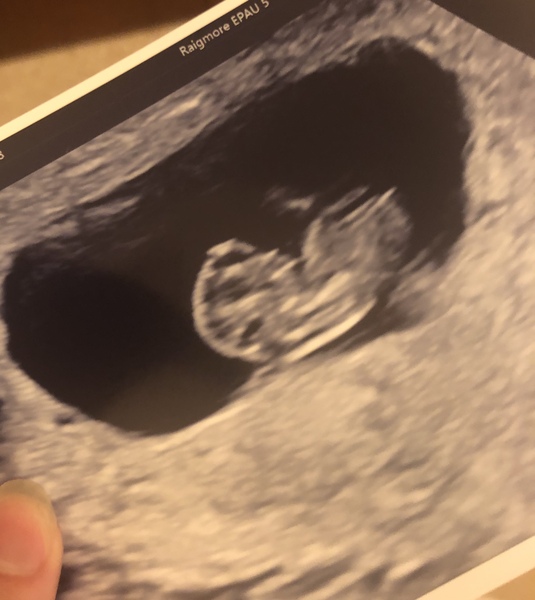The Graduates of TTC after pregnancy loss thread