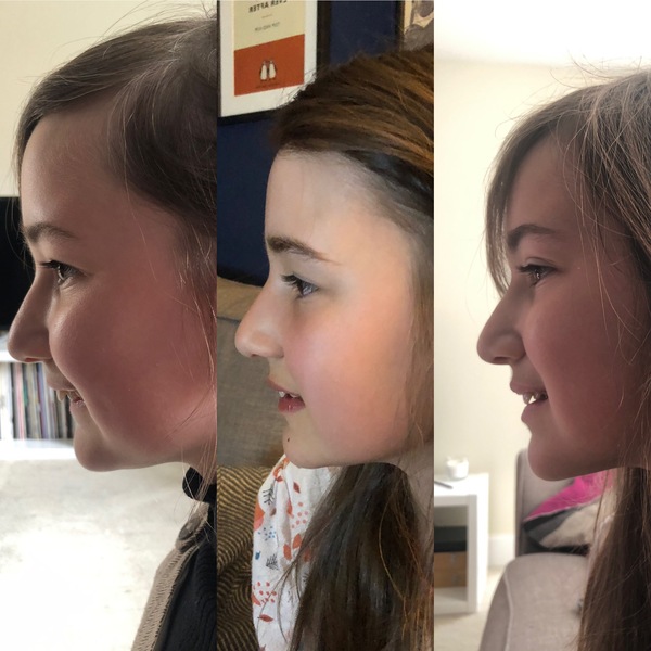 Twin Block Braces - Any Advice?