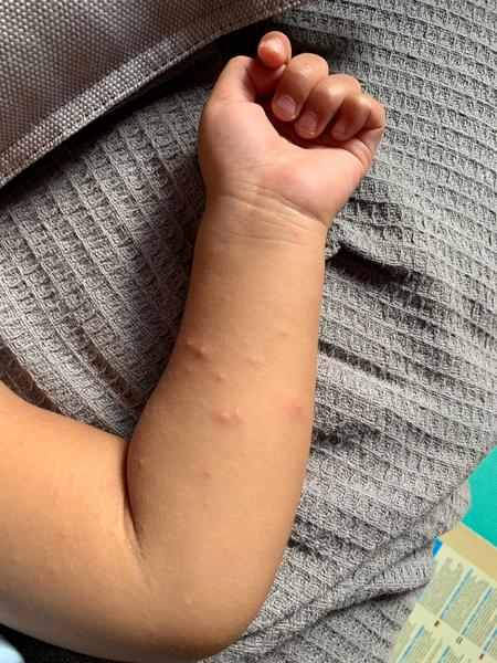 Is this the start of chicken pox ?