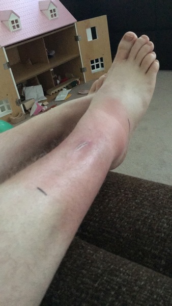 Infected leg- warning picture included!