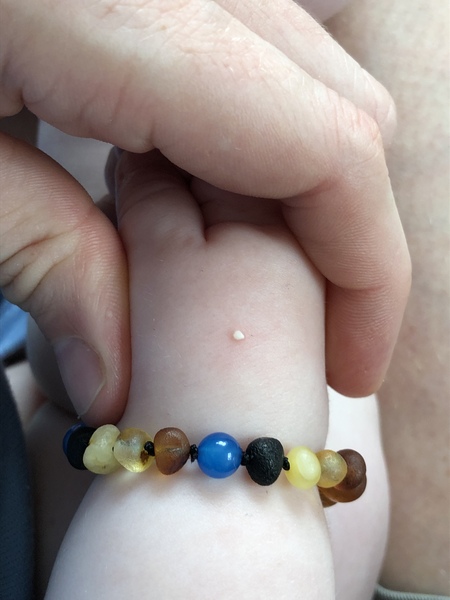 Anyone know what this is on my baby's hand? (Pic)