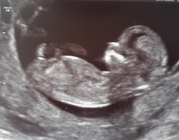Girl or boy- what do you think?