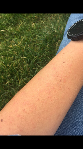 Suddenly allergic to the sun?