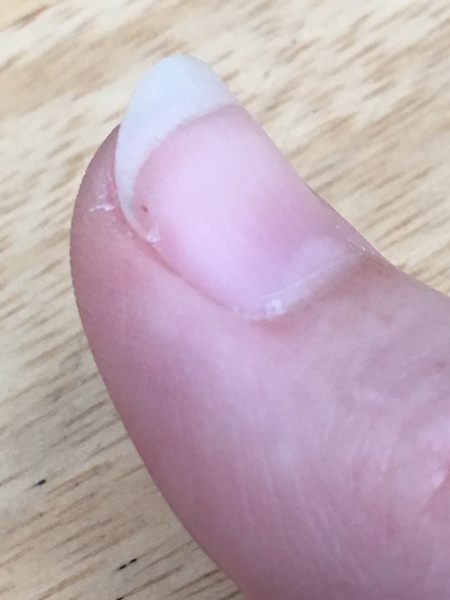 Do anyone else's nails do this?