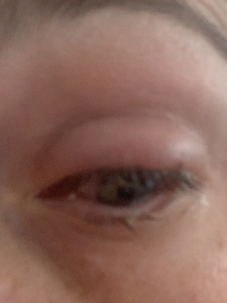 Contact lens or conjunctivitis
