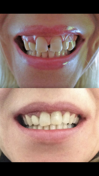 To ask about your experience of adult braces? Fitting tomorrow!