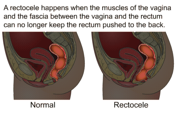 To ask if you have (or had) a prolapse after birth? I'm 25 and mortified
