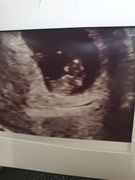 Second early scan! So nervous