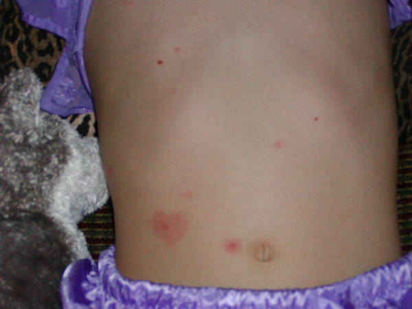 Atypical chickenpox