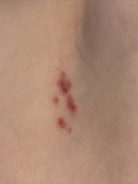 Any thoughts on this rash?