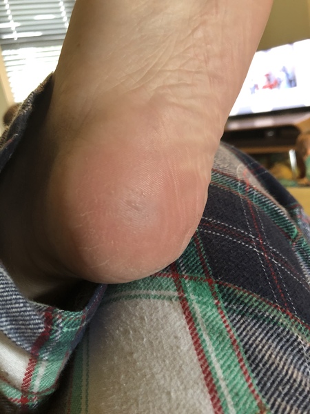 Anyone broken their heel?