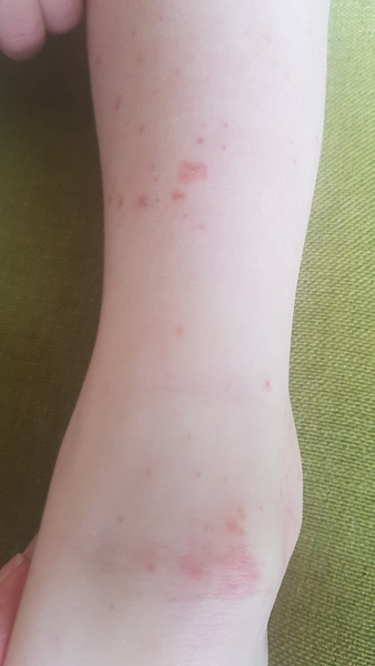 To ask if you recognise this rash?