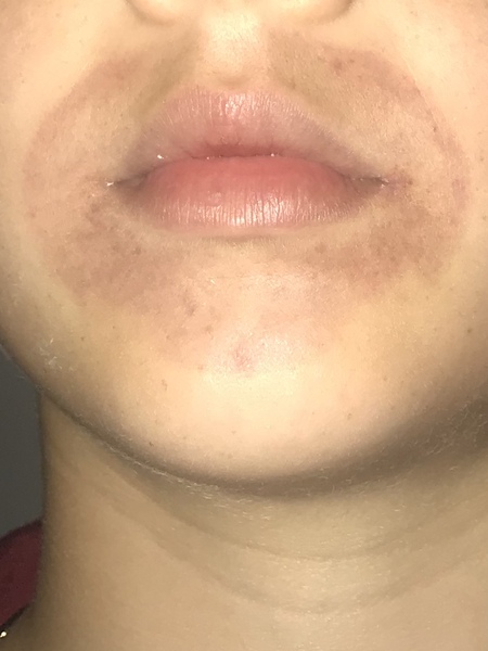 Ah fuck, DS has given himself a massive lovebite on his face