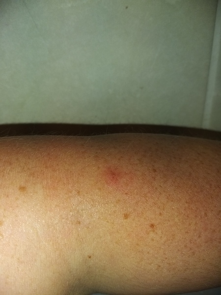 Aibu to be worried about this small lump?