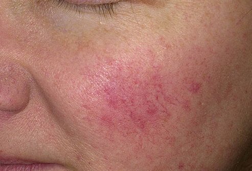 Rosacea