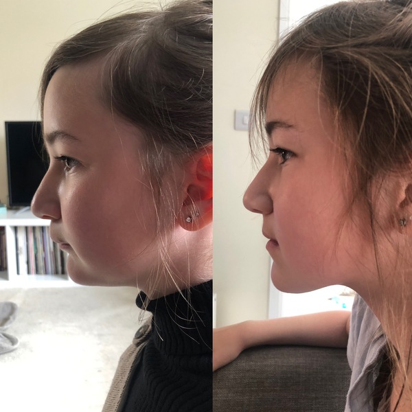 Twin Block Braces - Any Advice?