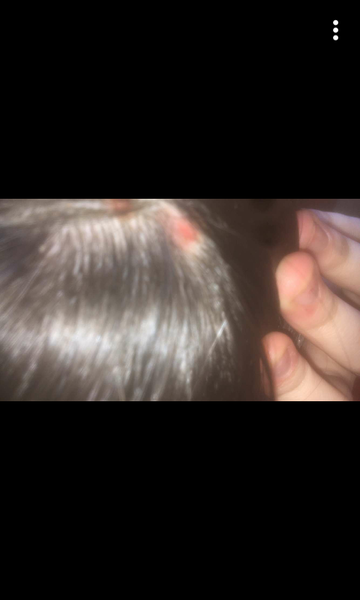 Should I get a mole on scalp biopsied or wait?