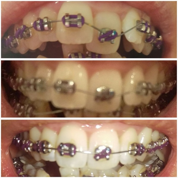 To ask about your experience of adult braces? Fitting tomorrow!