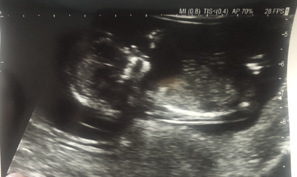 Due 23rd December - any one believe in nub theory?