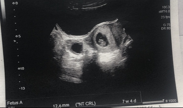 Does this look like a twin pregnancy?