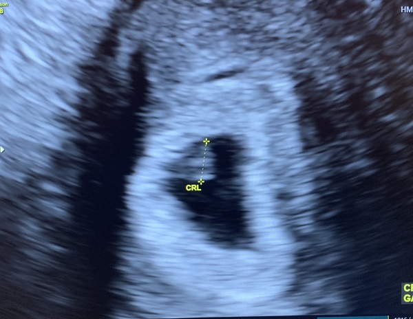 Threatening miscarriage. Success stories and handhold please