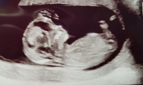 It’s going to absolutely drag until my scan!