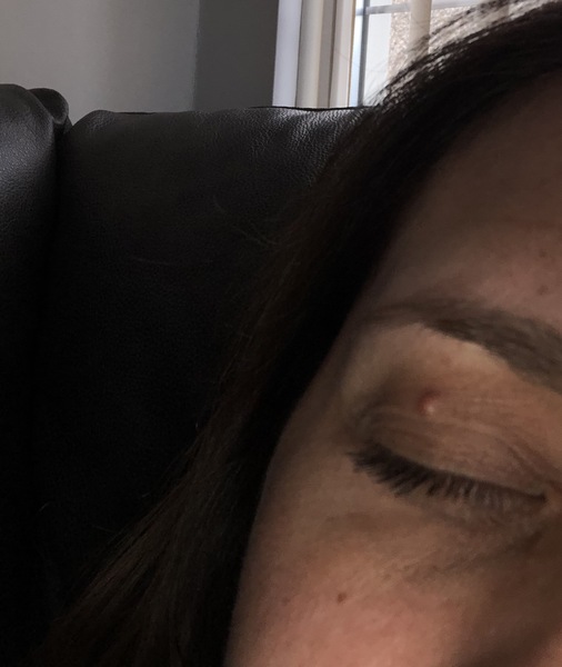 Can anyone tell me what this lump is?! (Eyelid)