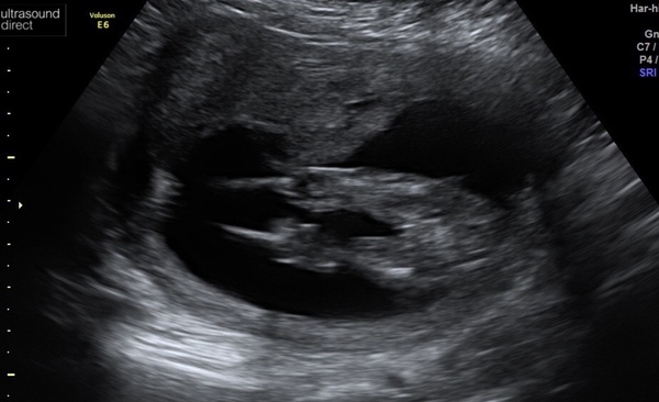 Private gender scan