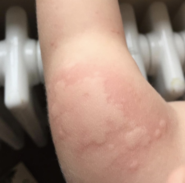 Is this heat rash...? Pic included