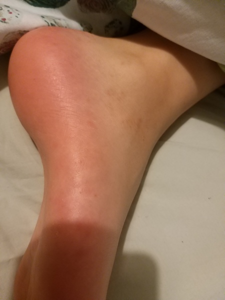 What is this rash? Google says diabetes