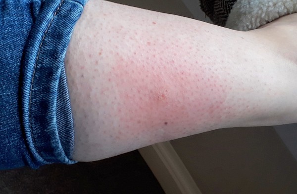 What the hell has bitten me and what should I do?