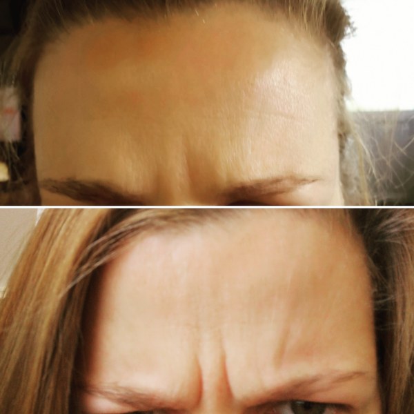 Migraine hangovers