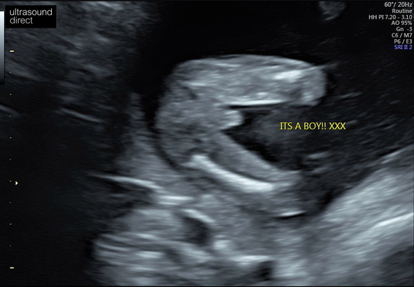 Gender scans??