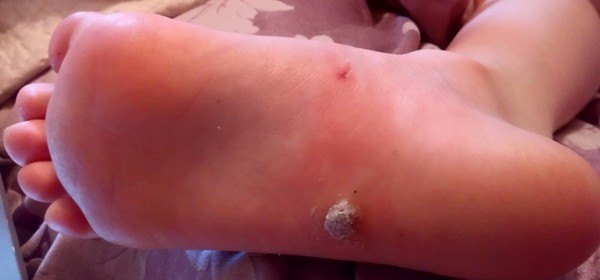 Verucca question, possible foot infection? Pic included, don't open while eating breakfast