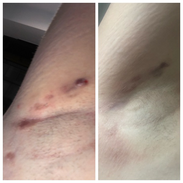 Hidradenitis Suppuritiva - Anything that works?